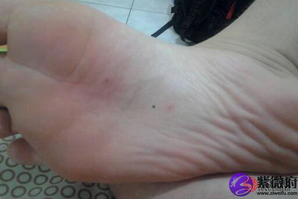 脚部痣相解读：揭秘不同脚部位置痣的深层含义