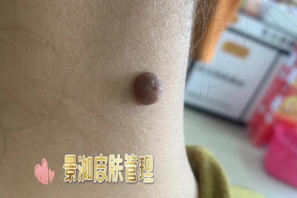 女性脖后痣的含义解析：揭秘脖子后部痣的象征意义