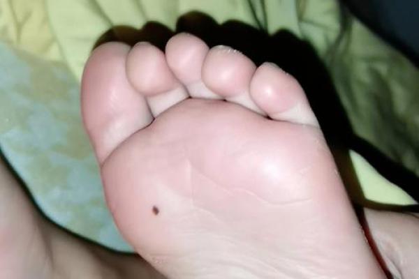 女性左脚痣解析集锦：深入探讨左脚底痣的女性特征分析