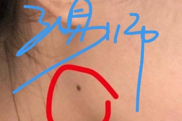 女性右侧脸颊痣解析：右侧腮痣对女性命运的影响探究