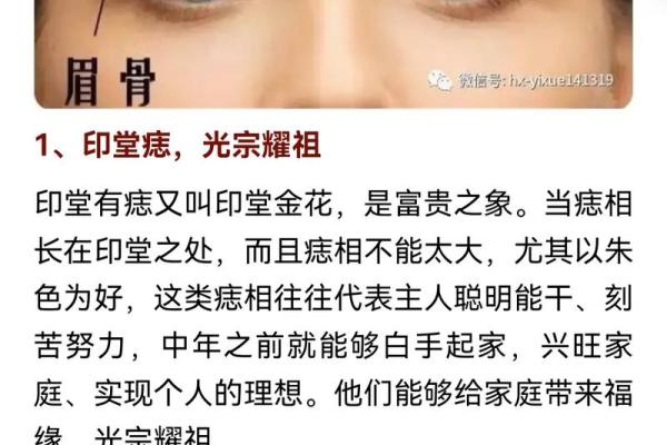 女性右侧脸颊痣解析：右侧腮痣对女性命运的影响探究